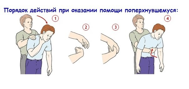 Прием Геймлиха у взрослых