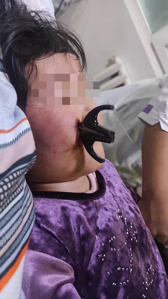 Девочка упала лицом на ножницы