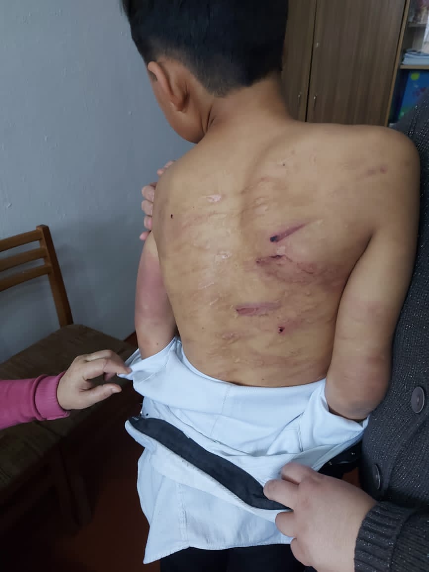 Следы от побоев