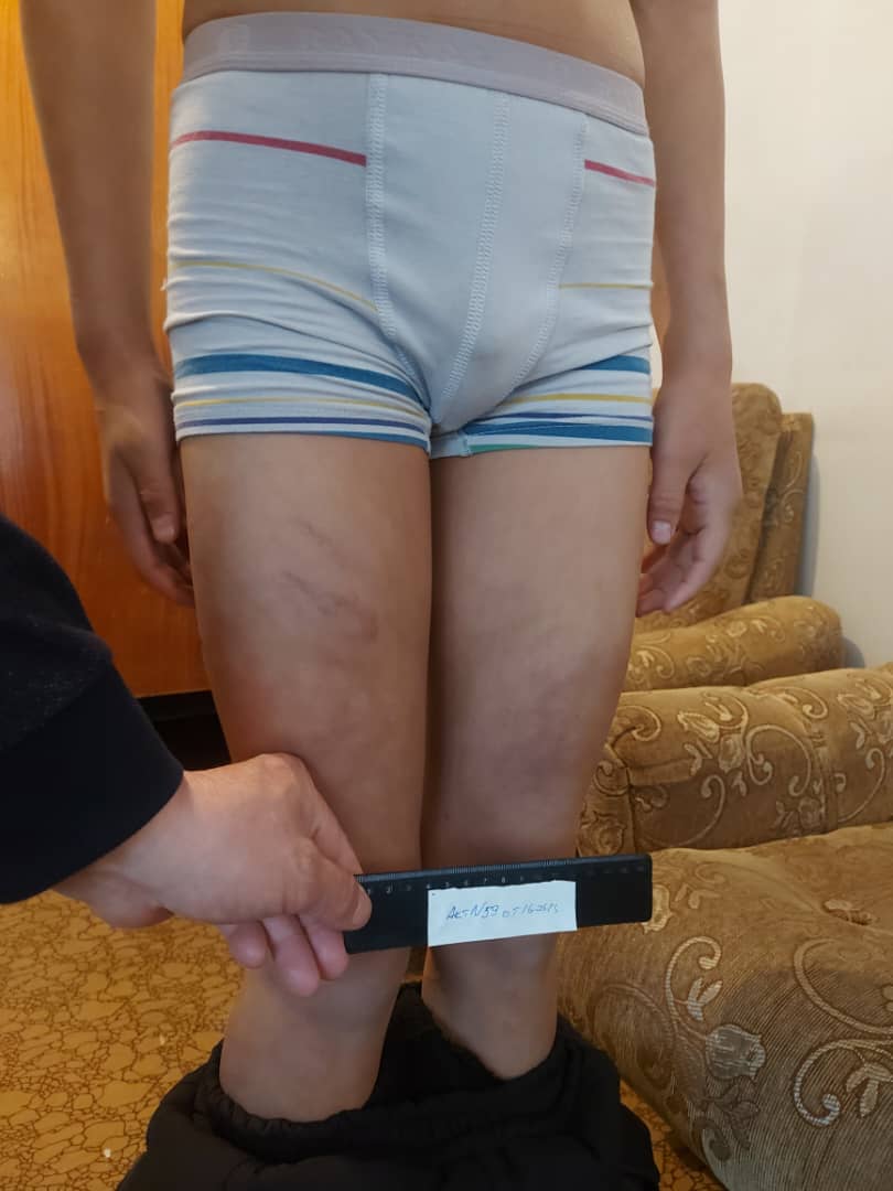 Следы от побоев