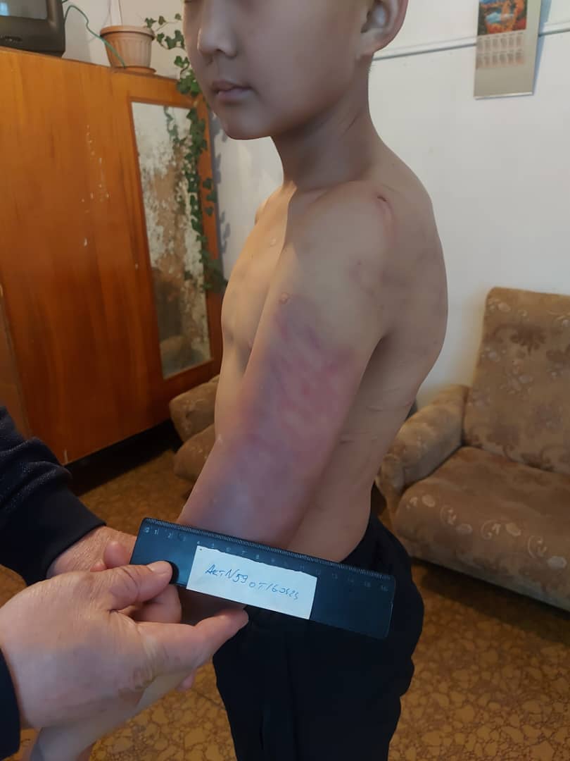 Следы от побоев