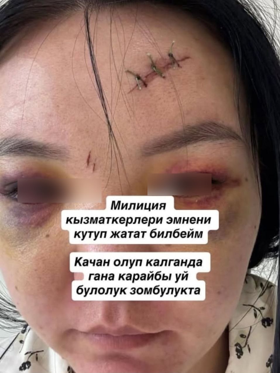Женщина показала травмы после избиения и раскритиковала выводы экспертов